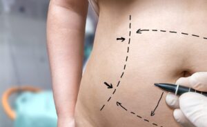 tummy tuck consultation