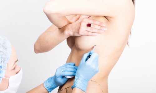 Female doctor makes dotted line on female body for cellulite correction. cosmetic surgery. lifting and breast augmentation