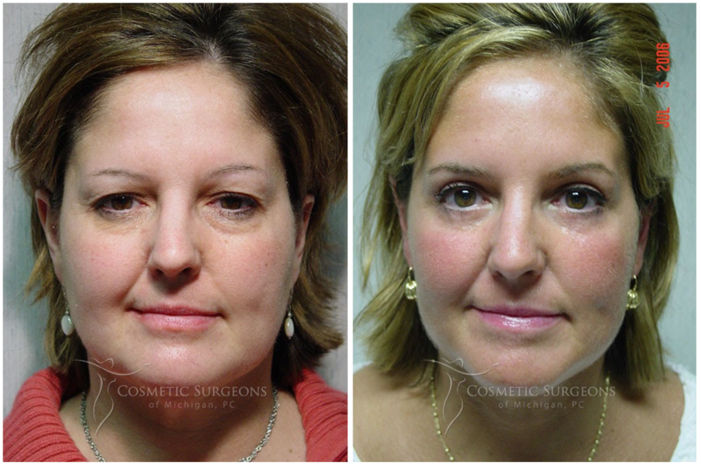 Actual patient of Dr. Goffas before and after eyelid lift surgery