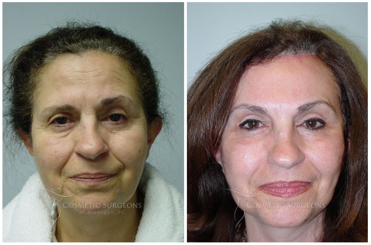 Actual patient of Dr. Goffas before and after forehead lift surgery.