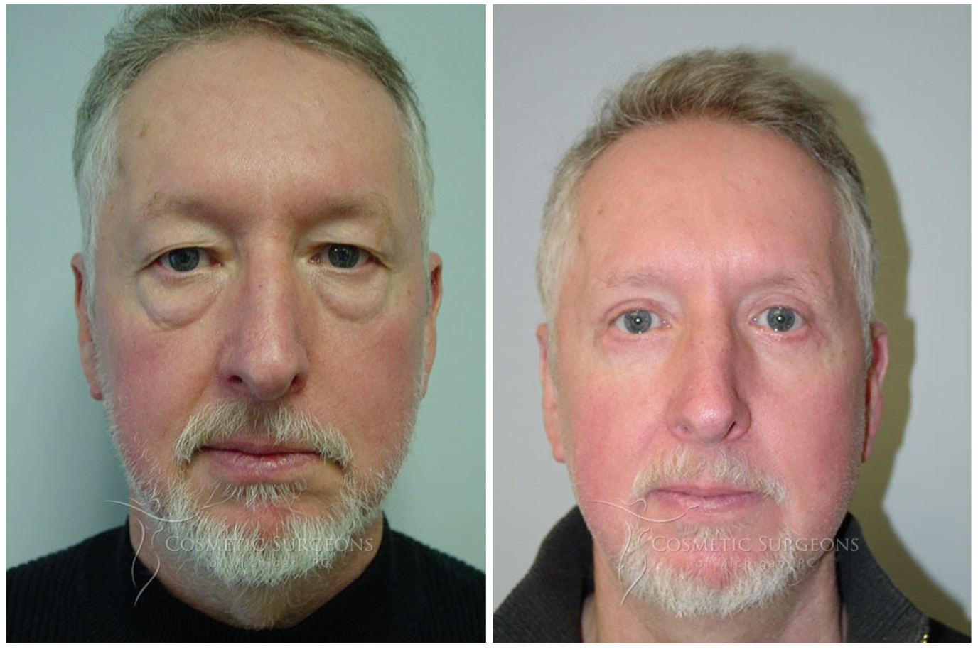 Actual male patient of Dr. Goffas Before and After Eyelid Lift Surgery