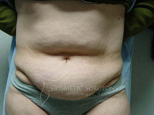 Abdominoplasty patient 2337