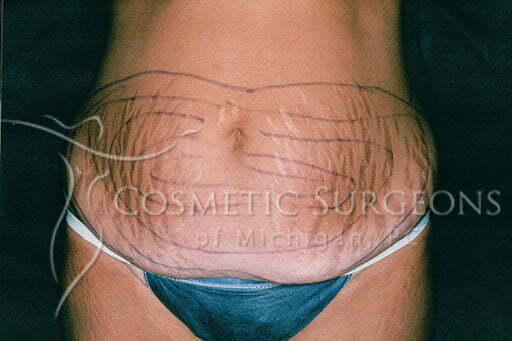 Abdominoplasty patient 2351