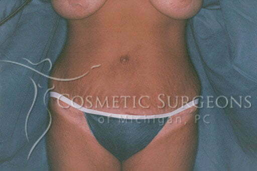 Abdominoplasty patient 2351