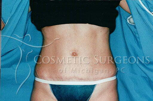 Abdominoplasty patient 2356