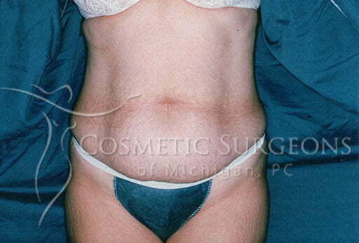 Abdominoplasty patient 2356