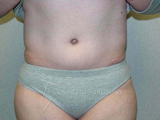 Abdominoplasty patient 2337