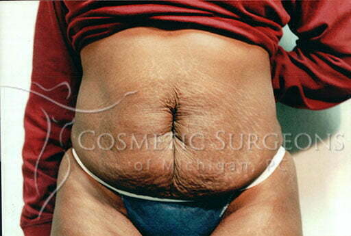 Abdominoplasty patient 2346