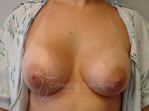Breast Augmentation patient 2627