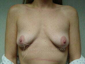 Breast Augmentation patient 2638