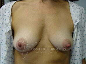 Breast Augmentation patient 2660