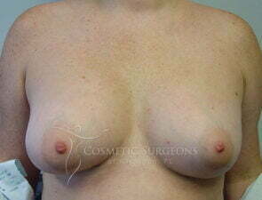 Breast Augmentation patient 2682