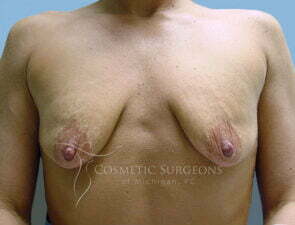 Breast Augmentation patient 2707