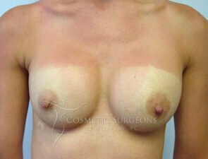 Breast Augmentation patient 2671