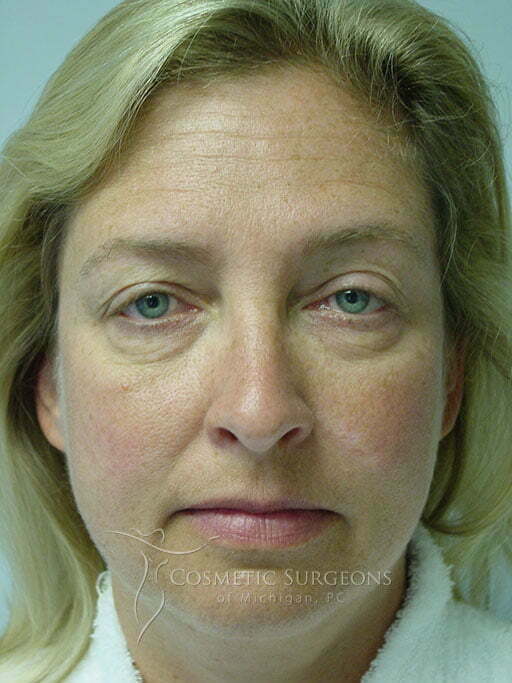 Eyelid Lift patient 2852