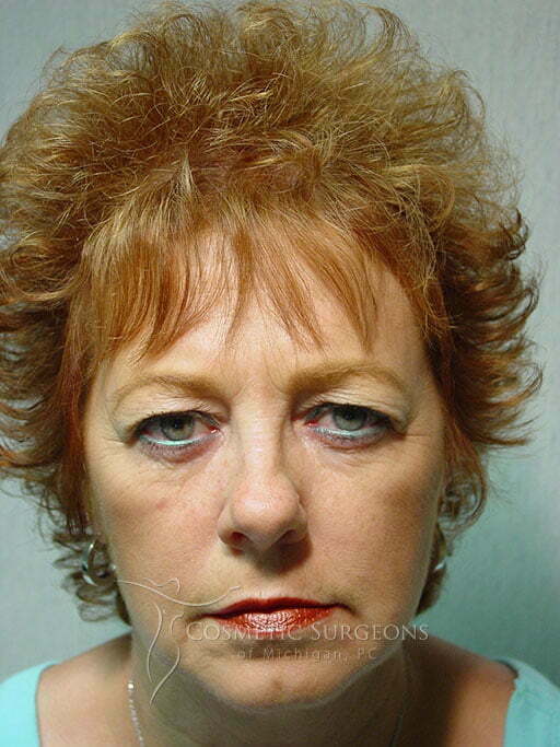 Eyelid Lift patient 2906