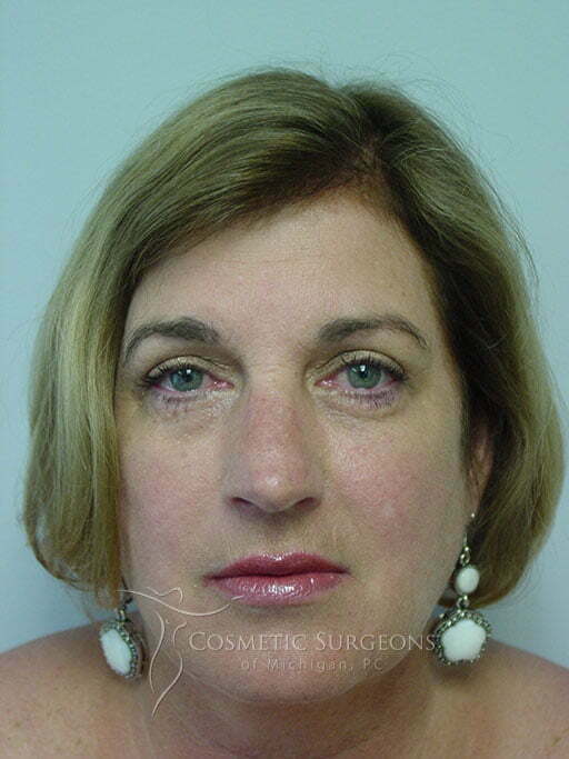 Eyelid Lift patient 2922