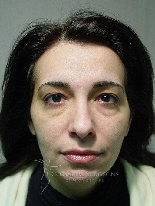 Eyelid Lift patient 2929