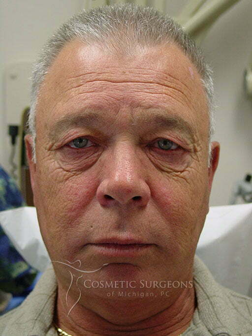 Eyelid Lift patient 2934