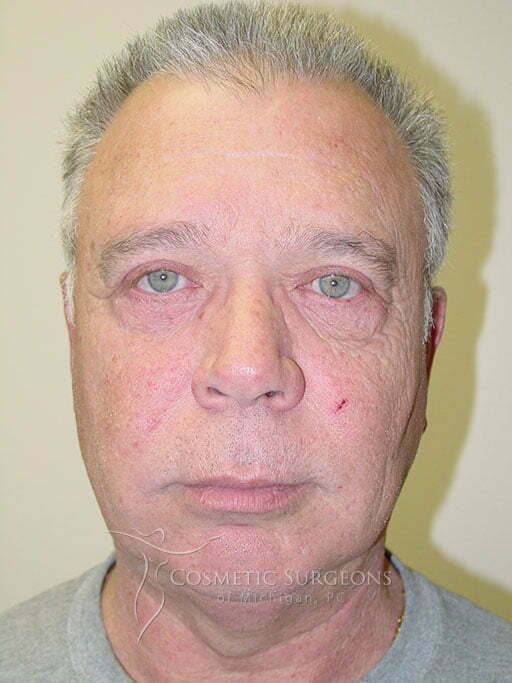 Eyelid Lift patient 2934