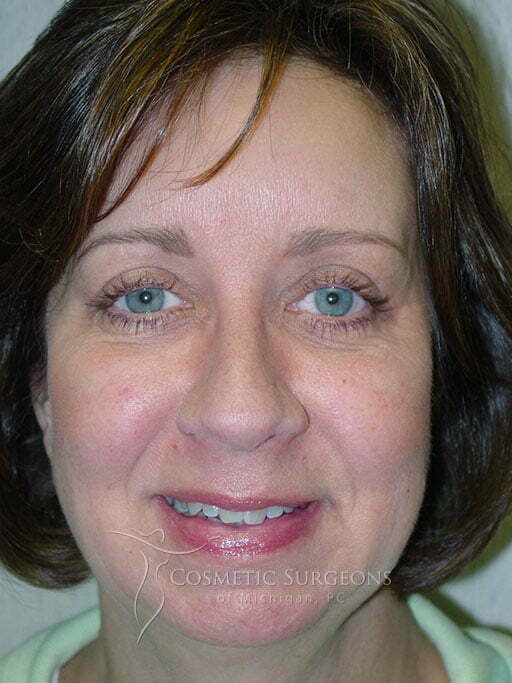Eyelid Lift patient 2957