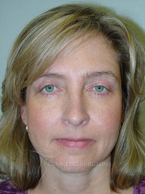 Eyelid Lift patient 2852