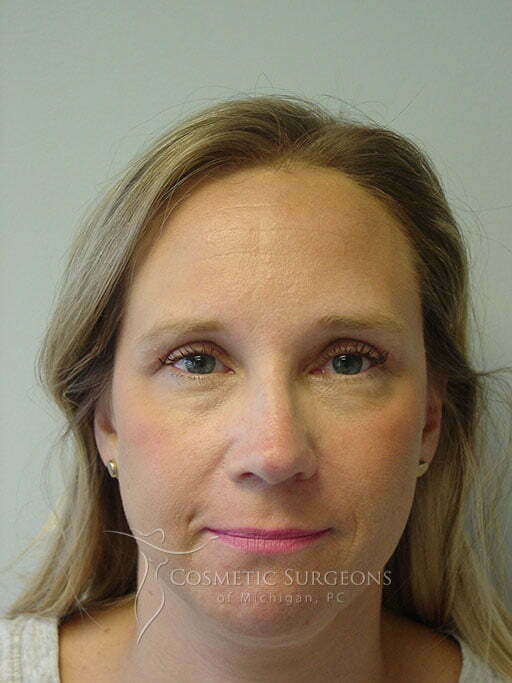 Eyelid Lift patient 2987