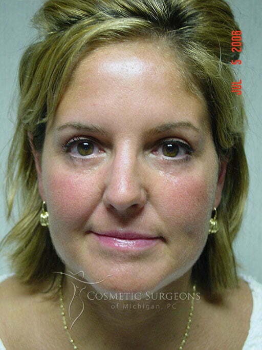 Eyelid Lift patient 2996