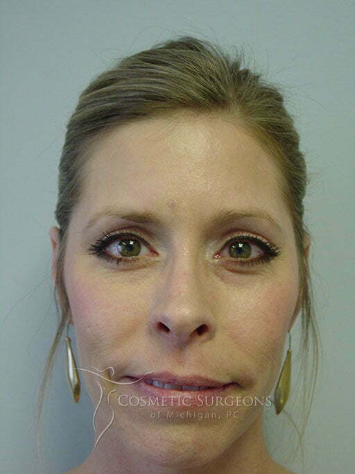 Eyelid Lift patient 3005