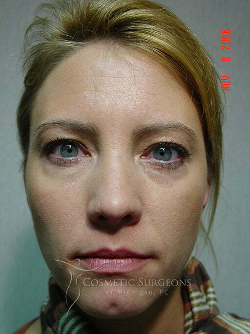 Eyelid Lift patient 2861