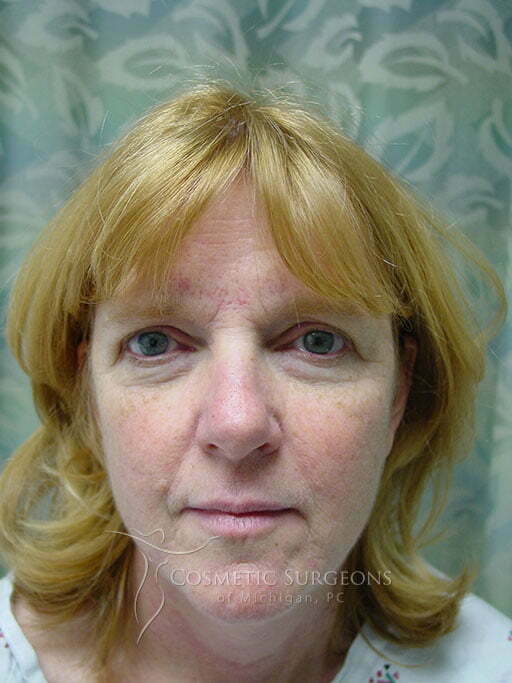 Eyelid Lift patient 2939