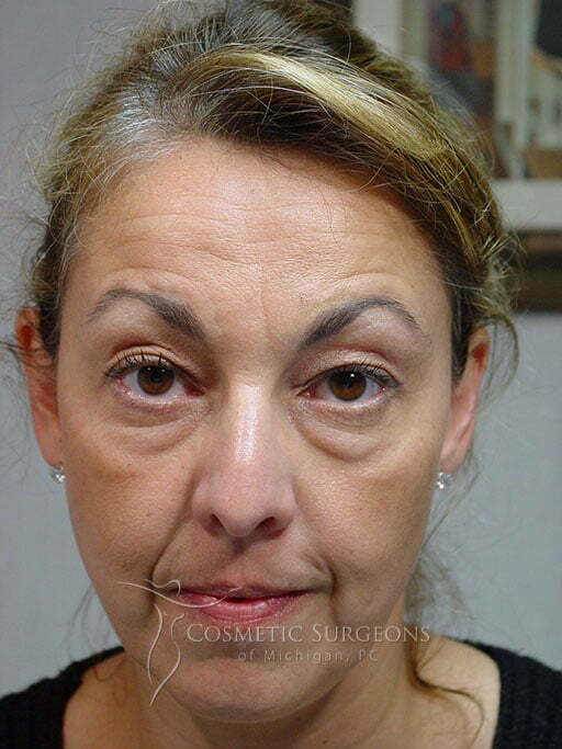 Eyelid Lift patient 2897