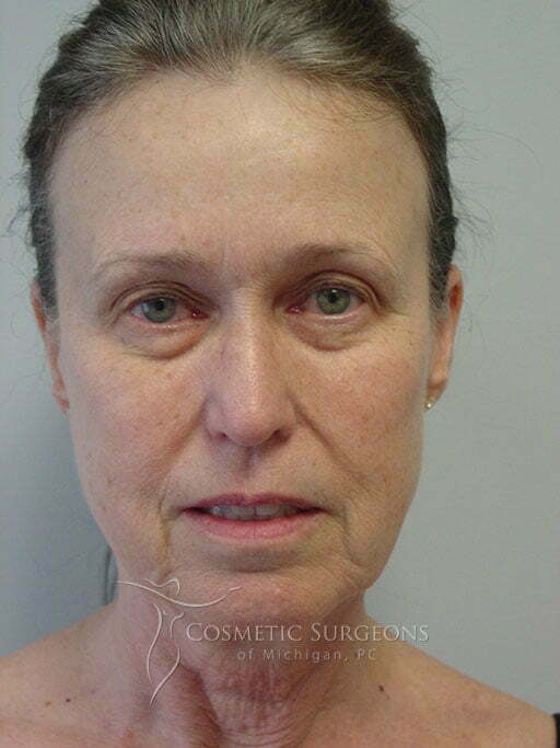 Facelift patient 3065