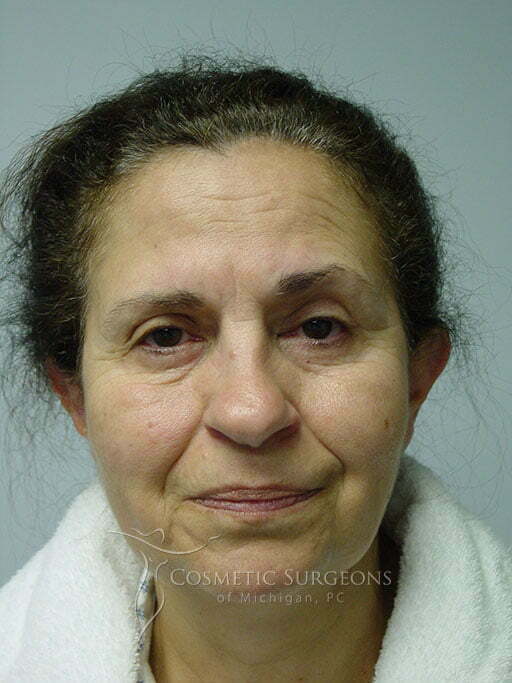 Forehead Lift patient 3028