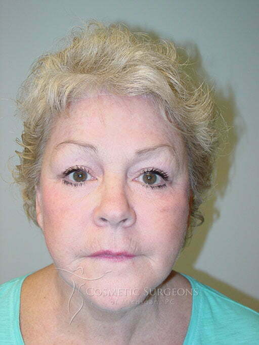 Forehead Lift patient 3052