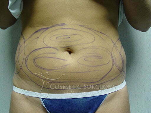 Liposuction patient 3222