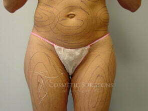 Liposuction patient 3231