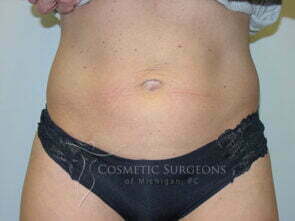 Liposuction patient 3231