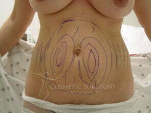 Liposuction patient 3240