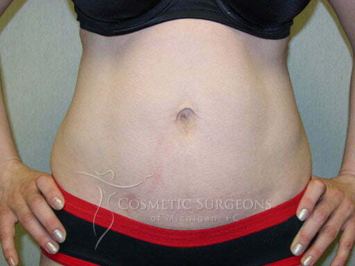 Liposuction patient 3240