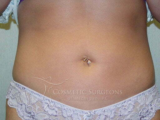 Liposuction patient 3222