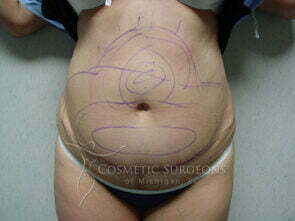 Liposuction patient 3247
