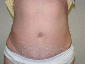 Liposuction patient 3247