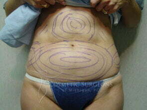 Liposuction patient 3254