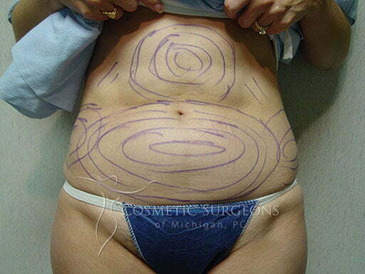 Liposuction patient 3254