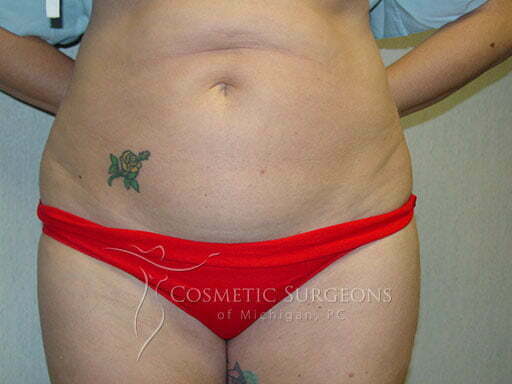 Liposuction patient 3254