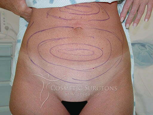 Liposuction patient 3261