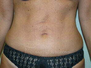 Liposuction patient 3261