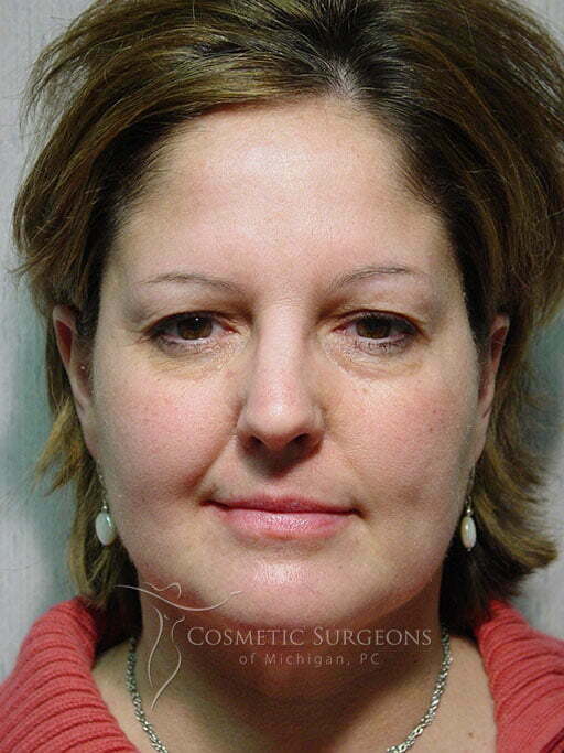 Liposuction patient 3268