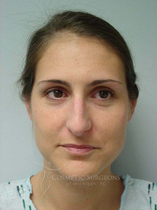 Nose Surgery patient 3332